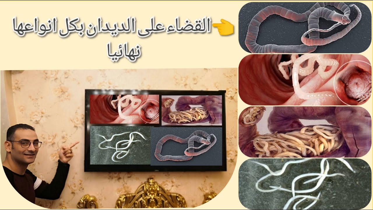 البلهارسيا و الهايمينوليبس نانا (الدودة الشريطيه القزمه) و القضاء عليهم نهائيا