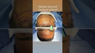 Hairline Lowering Surgery