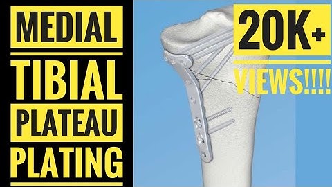 Medial Approach and Plating of Medial Tibial Condyle