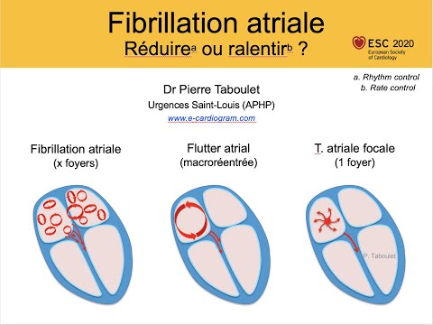 Vidéo: Fibrillation Auriculaire (FA): Quel Est Mon Pronostic?
