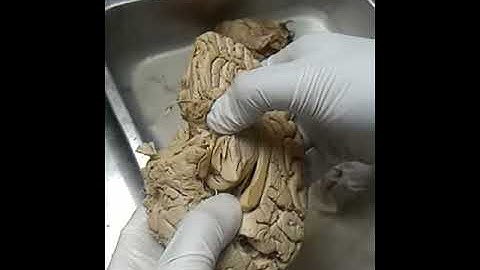 Optic tract and pulvinar