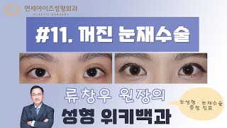 꺼진눈 재수술의 모든것 (원인, 지방이식, 지방재배치, 안검하수 등 해결)