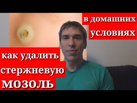 Как удалить стержень сухой мозоли в домашних условиях