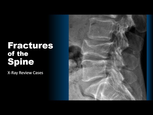 X-ray of spinal stress fracture - Fractures of the Spine X-Ray Cases #radiology #spine #trauma ...