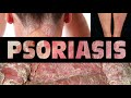 PSORIASIS, Bukan penyakit kulit! — Dr. Noordin Darus