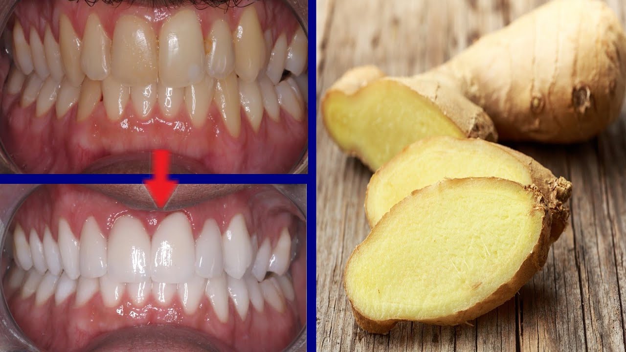 Magical Teeth Whitening Remedy, Get whiten Teeth at home in 4 minutes ...