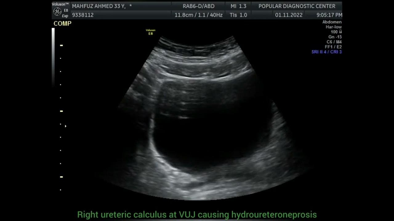 Right ureteric calculus at VUJ YouTube