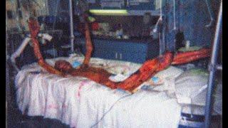 A MAN WHO LIVED SKINLESS FOR 83 DAYS | GRAPHIC CONTENT