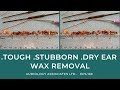 🔴TOUGH 🔴STUBBORN 🔴DRY EAR WAX REMOVAL - EP 169