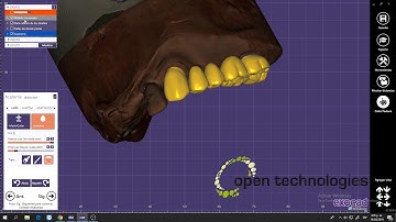 Exocad Bridge Design