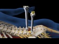 Lumbar Fusion of L5 S1 Animation