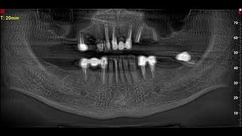 Ridge Augmentation and Implant Placement using L PRF