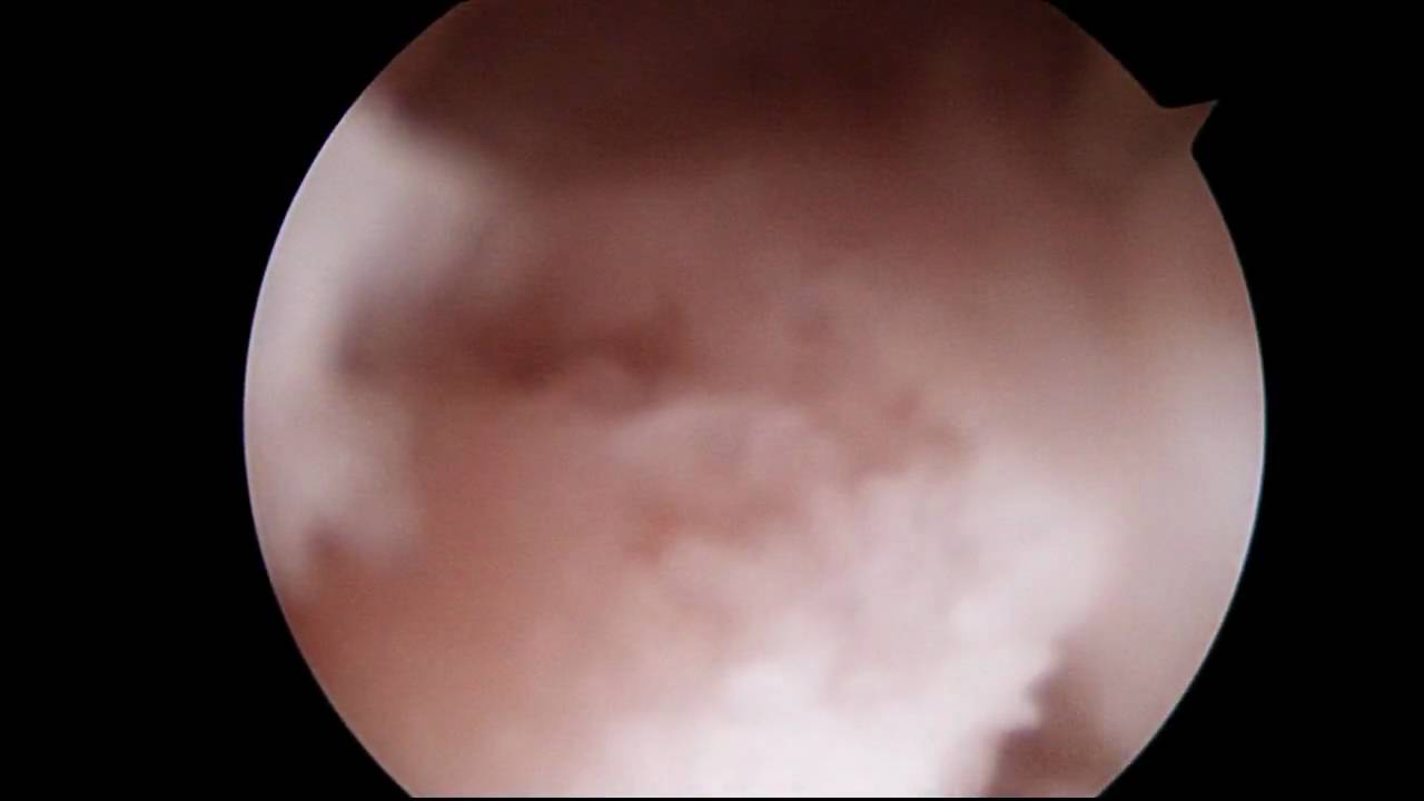 Gazza's Left Knee Microfracture Surgery Segment 6 of 9