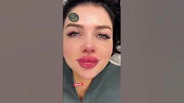 Lips Filler فيلر شفاه 