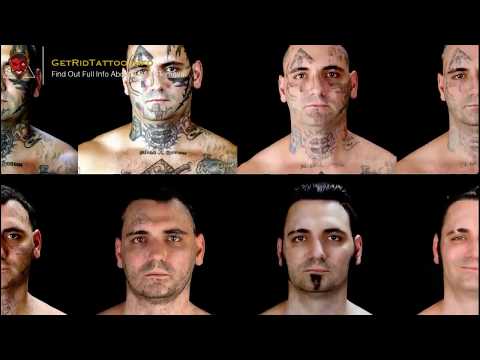 laser-tattoo-removal-aftercare-–-all-you-need-to-learn-about-tattoo-removal.-page-teaser
