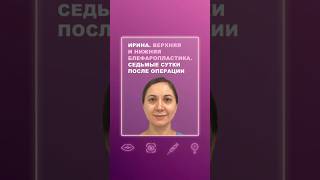 Ирина. Верхняя и нижняя блефаропластика. Седьмые сутки после операции