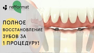 🤔 Как проходит имплантация зубов все на 4. Имплантация зубов все на 4. 12+