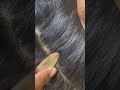 #fypviralシ #statisfying #Lice #hair #LiceOnHead #liceremoval #brasil #xyzbcafyp #licepopping #kutu