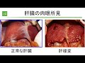 肝臓がんの治療