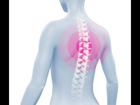 Видео: Прищипан нерв в горната част на гърба: причини, лечения и др