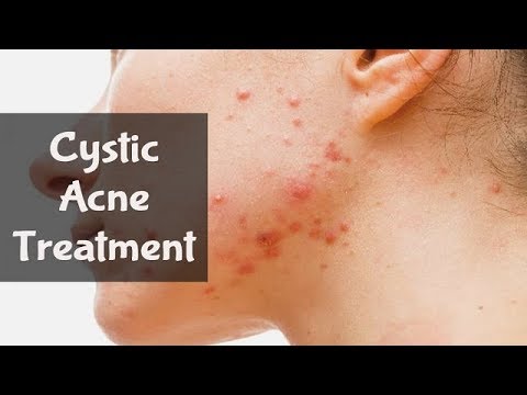 5 Natural Cystic Acne Treatments that Really Work | By Top 5.
