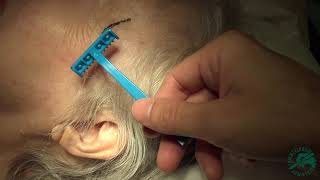 Temporal artery biopsy