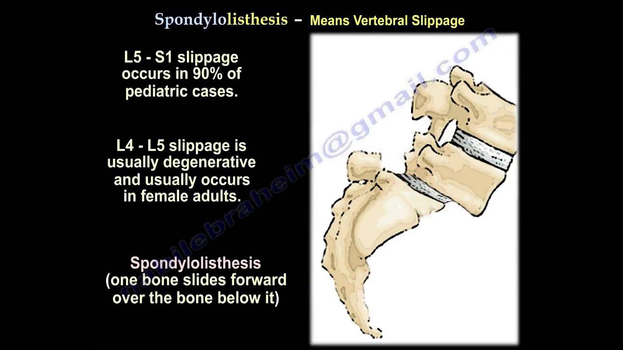 spondylosis and spondylitis