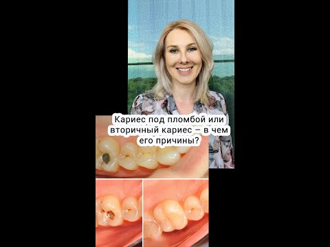 Кариес под пломбой или вторичный кариес – в чем его причины?
