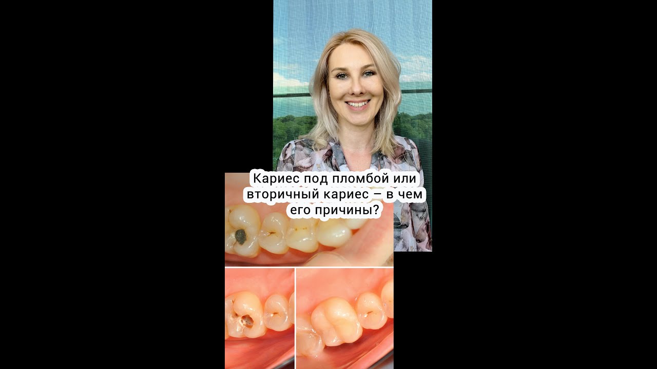Кариес под пломбой или вторичный кариес – в чем его причины?