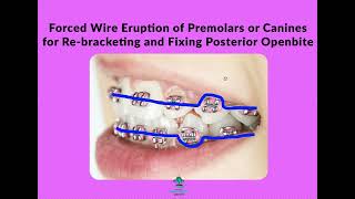 protruding-wire - Cream Ridge Orthodontics