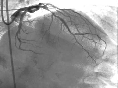 Стентирование коронарных артерий