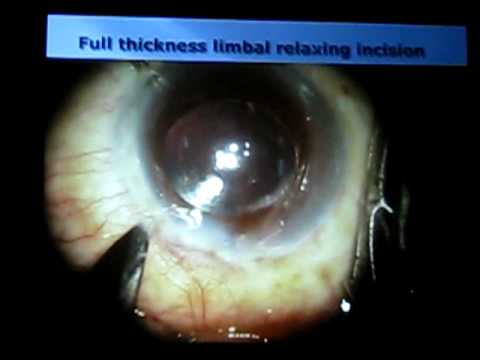 limbo relaxing incision limbo relaxing incision