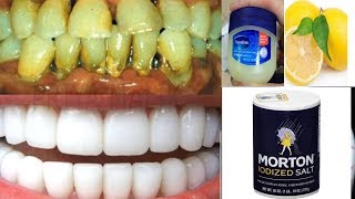 Powerful remedy Get white teeth in 2 minutes
