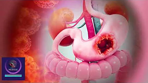 Upper Endoscopy (EGD) Procedure – When and Why It's Done