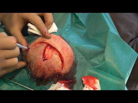 Double rotation flap. #132