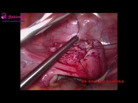 Video: Endometrioid Cysta - Behandling, Kirurgi, Borttagning