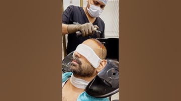 First Head Wash After Hair Transplant (Results) | Cara Clinic