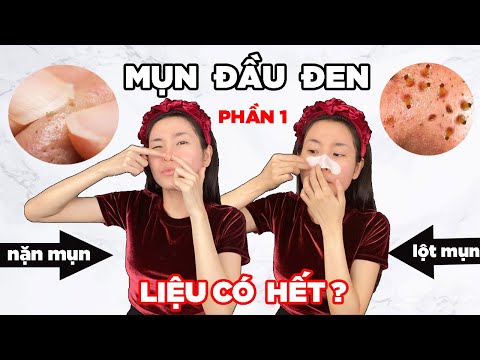 |Phần 1|TRỊ SẠCH MỤN ĐẦU ĐEN MÀ KHÔNG CẦN NẶN HAY LỘT MỤN| Lý do tại sao không nên nặn hay lột mụn❗❓