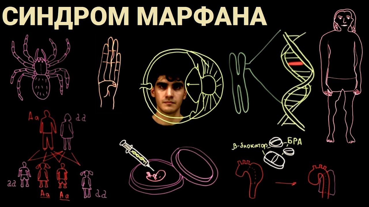 Синдром (болезнь) Марфана 12 месяцев #7 - YouTube