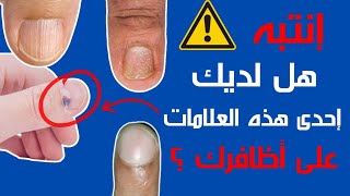 علامات الاظافر والامراض | 8 علامات تدل على أمراض خطيرة لا تتجاهلها أبدا