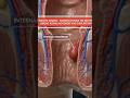 Hemorrhoids 3d animation #3danimation #medicalanimation #healthcare