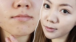 DILUAR DUGAAN!! Inilah Cara Menghilangkan Bekas Jerawat & Flek Hitam Secara Alami - Durasi: 7.35. 