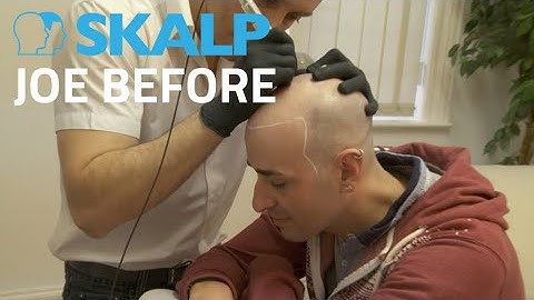 Scalp Micropigmentation by Skalp® Joe Before Treatment