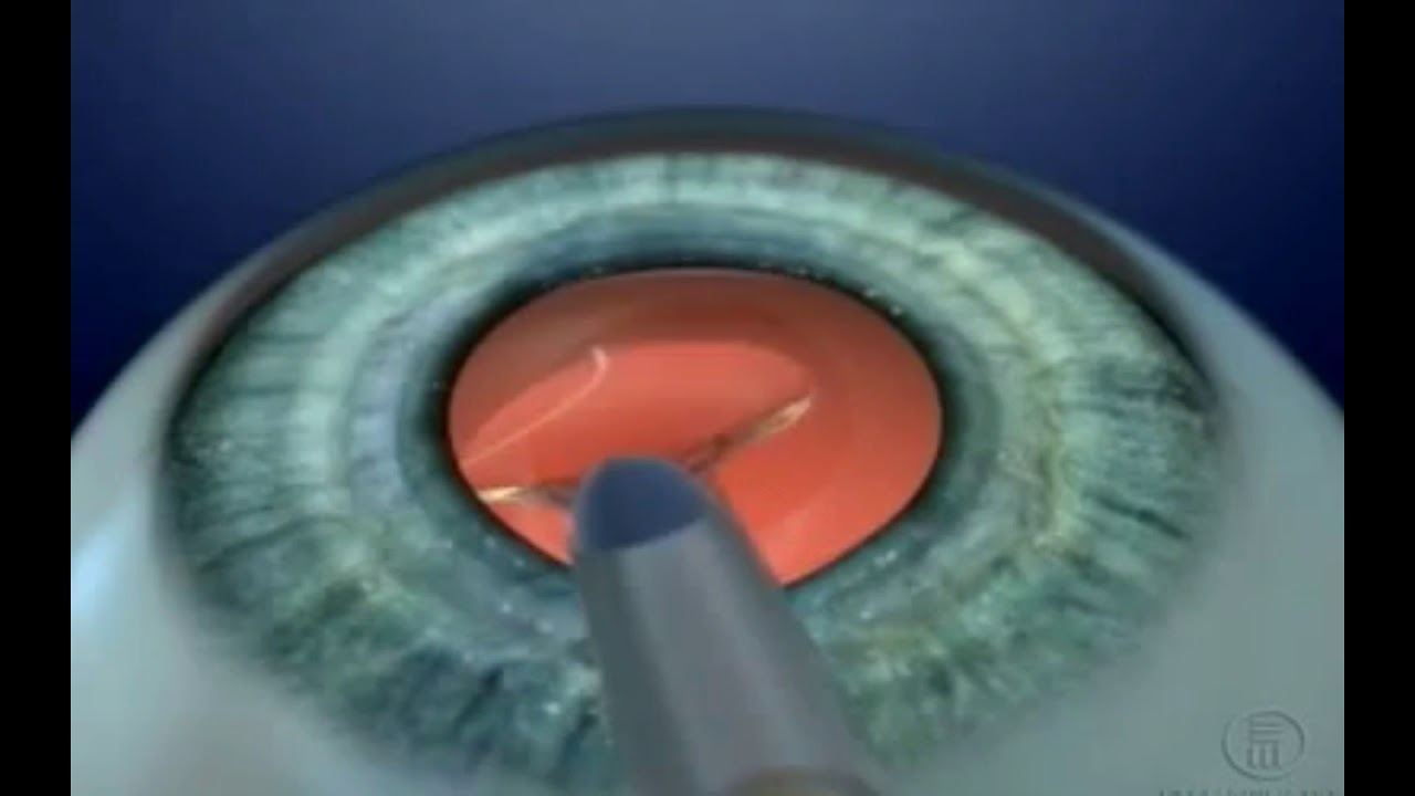 Calculo De Lente Intraocular Lentes de intraoculares - YouTube