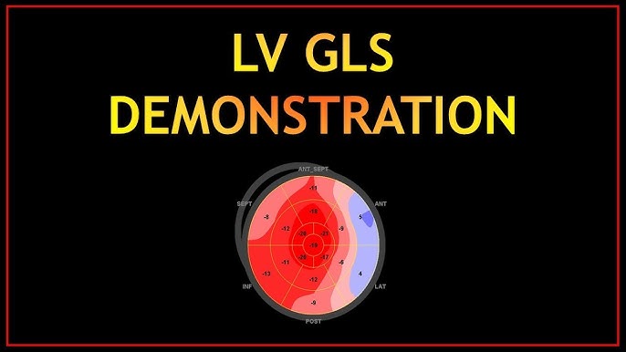 Example of calculation of global longitudinal strain (GLS) by 2D