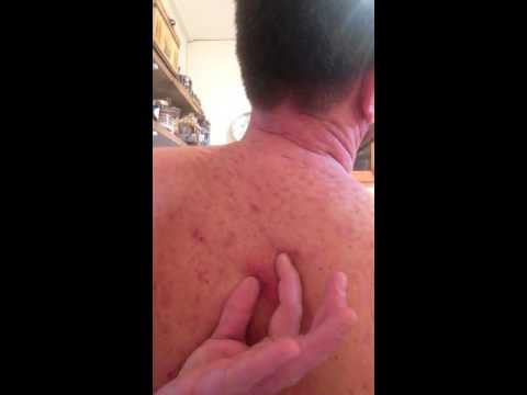 Back-acne cyst popping