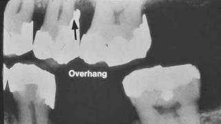 Dental Radiograph Pathology & Restorations :: Part I