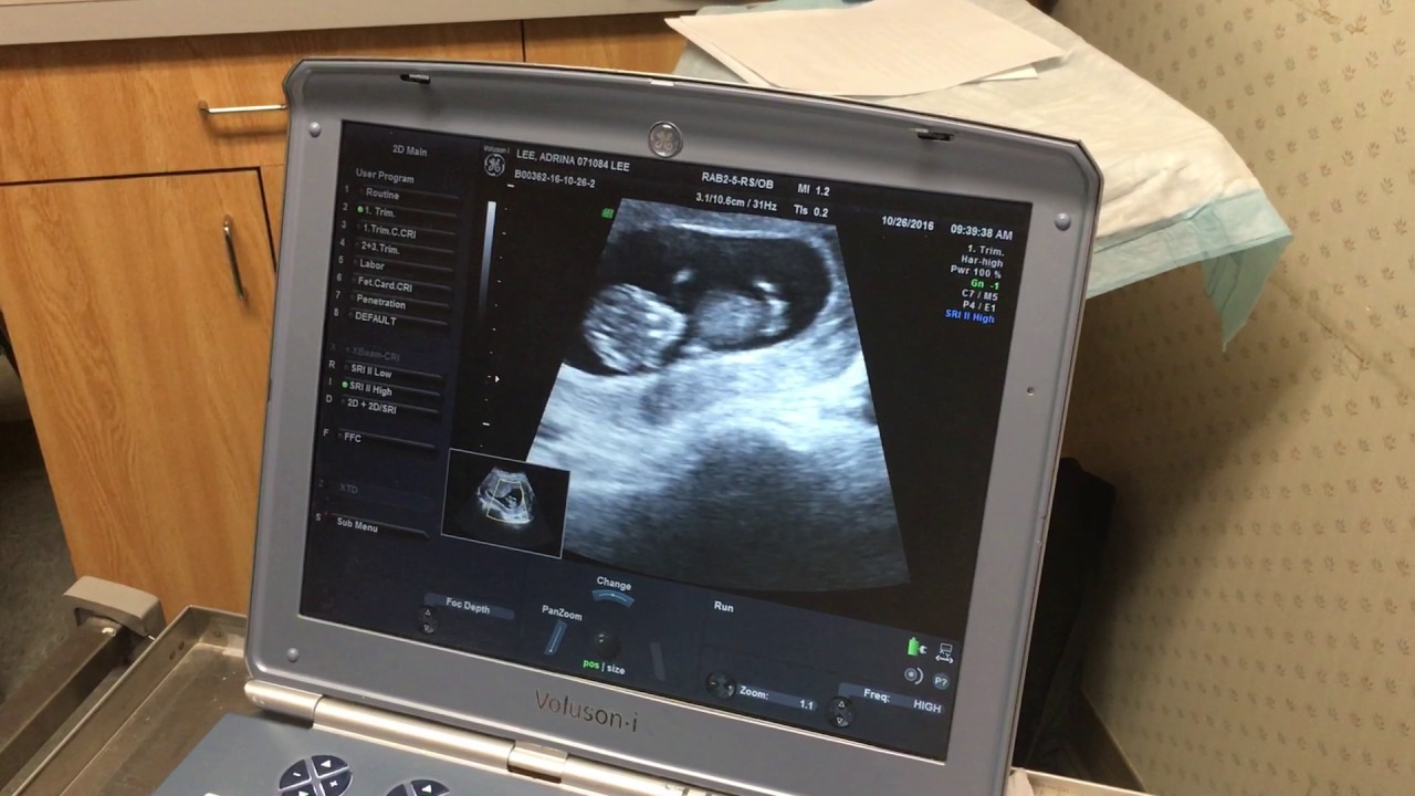 First Ultrasound of Baby Lee - 10/26/16 camera iphone 8 plus apk