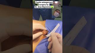 Penile enlargement surgery by Dr. Araz Bayramov - Penis Surgery - www.penilenlargement.com