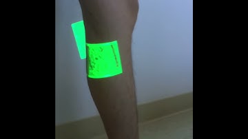 OC Vein Care - Live Mapping of Leg Veins